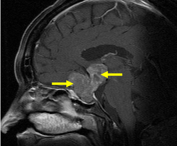 写真：下垂体腺腫2