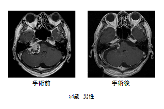 写真：手術前後の比較、54歳男性の例