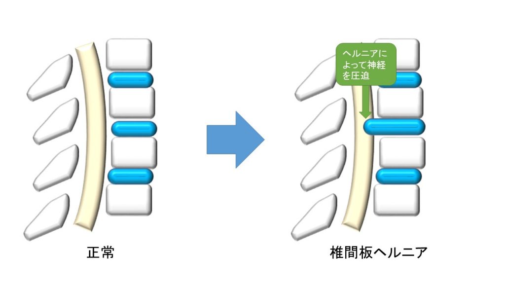 イラスト：椎間板ヘルニアのイメージ