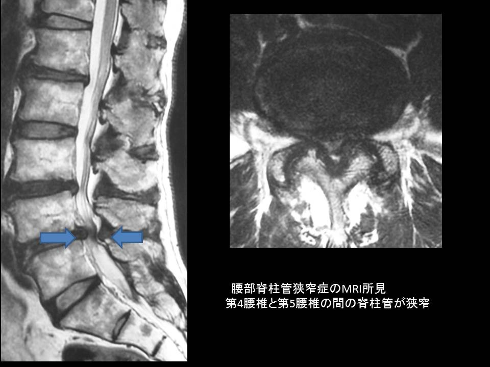 腰部脊柱管狭窄症のMRI写真
