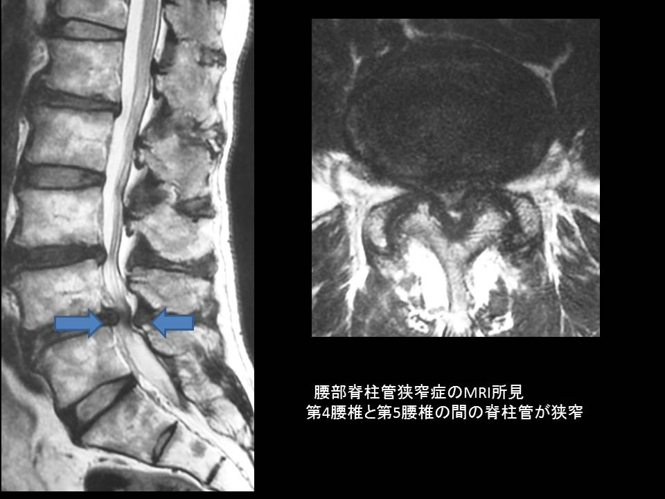 症 狭窄 脊柱 管 脊柱管狭窄症、椎間板ヘルニアの手術を得意とする病院リスト