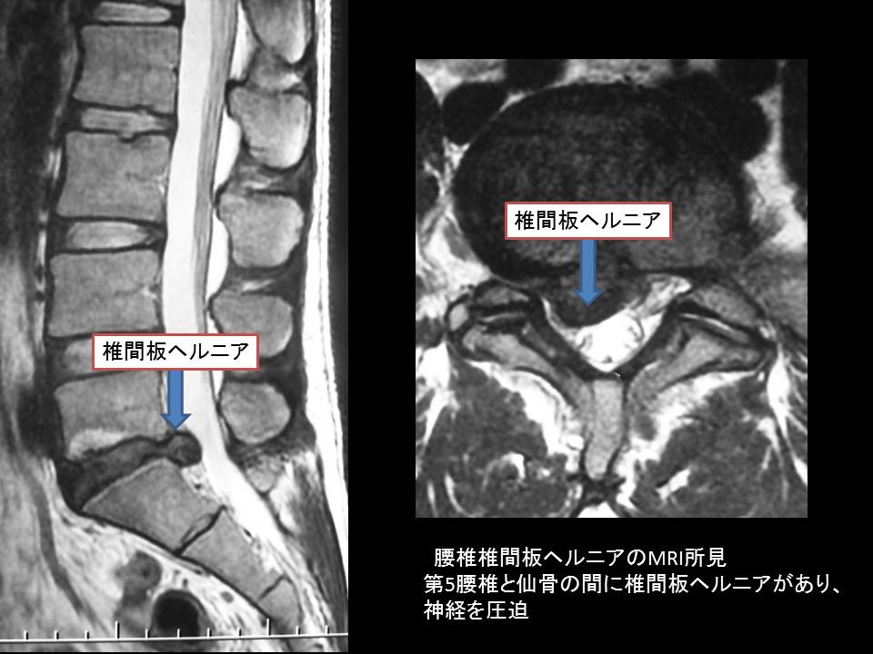 腰椎椎間板ヘルニア 秋田県立循環器 脳脊髄センター