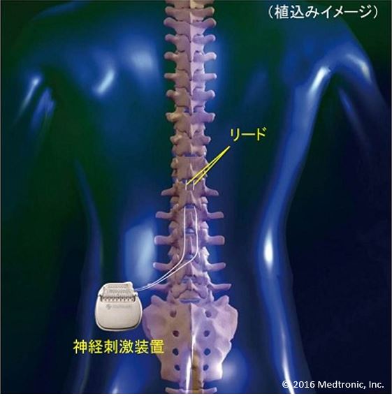 イラスト：脊髄刺激療法のイメージ図