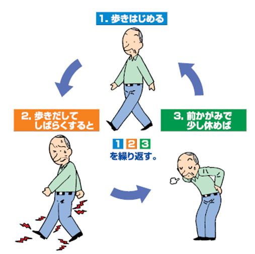 腰部脊柱管狭窄症 秋田県立循環器 脳脊髄センター